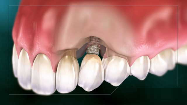 выпадения зубных имплантов